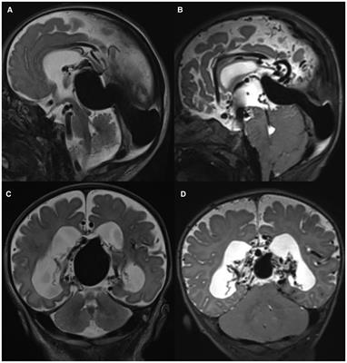 Neurodevelopmental and genetic findings in neonates with intracranial arteriovenous shunts: A case series